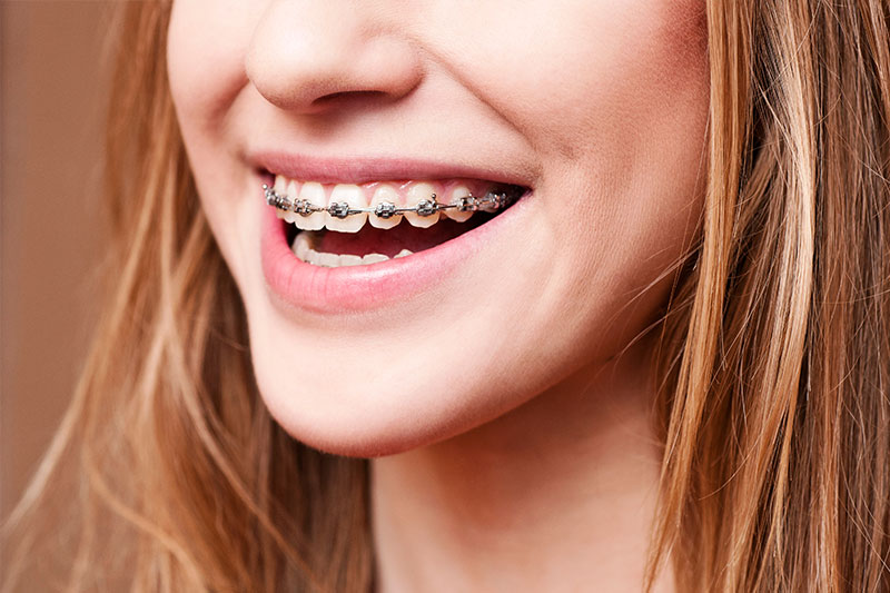 Orthodontics in South Windsor
