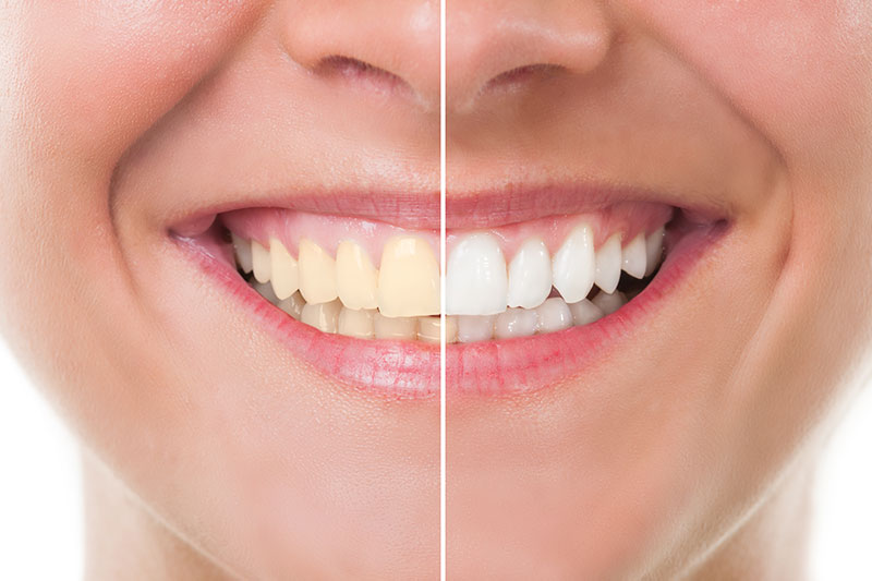 Teeth Whitening in South Windsor